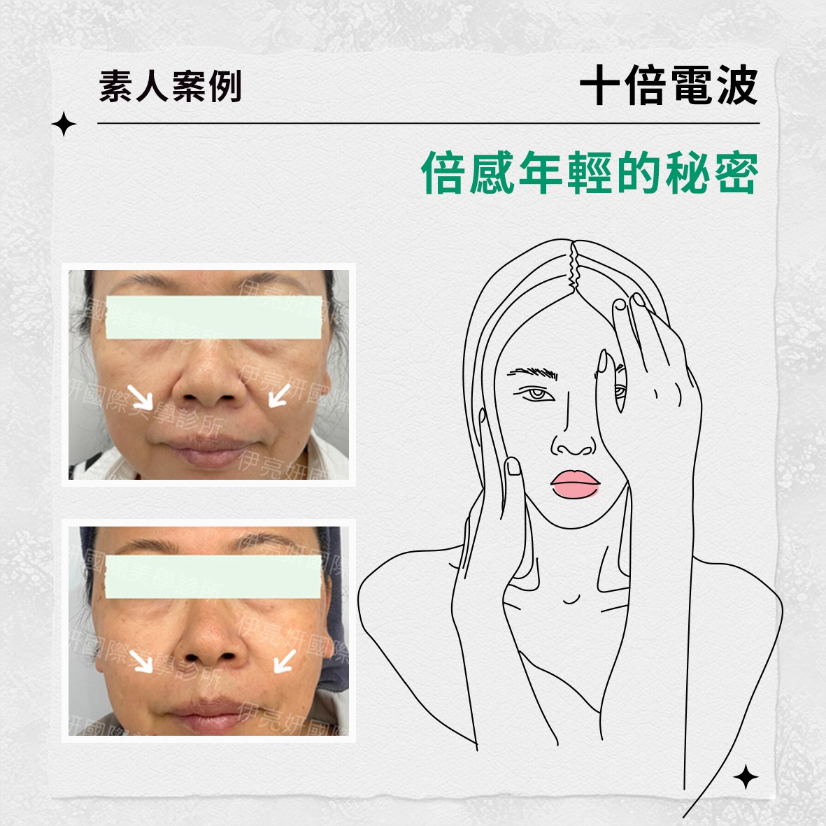 素人案例 |十倍電波，倍感年輕的秘密