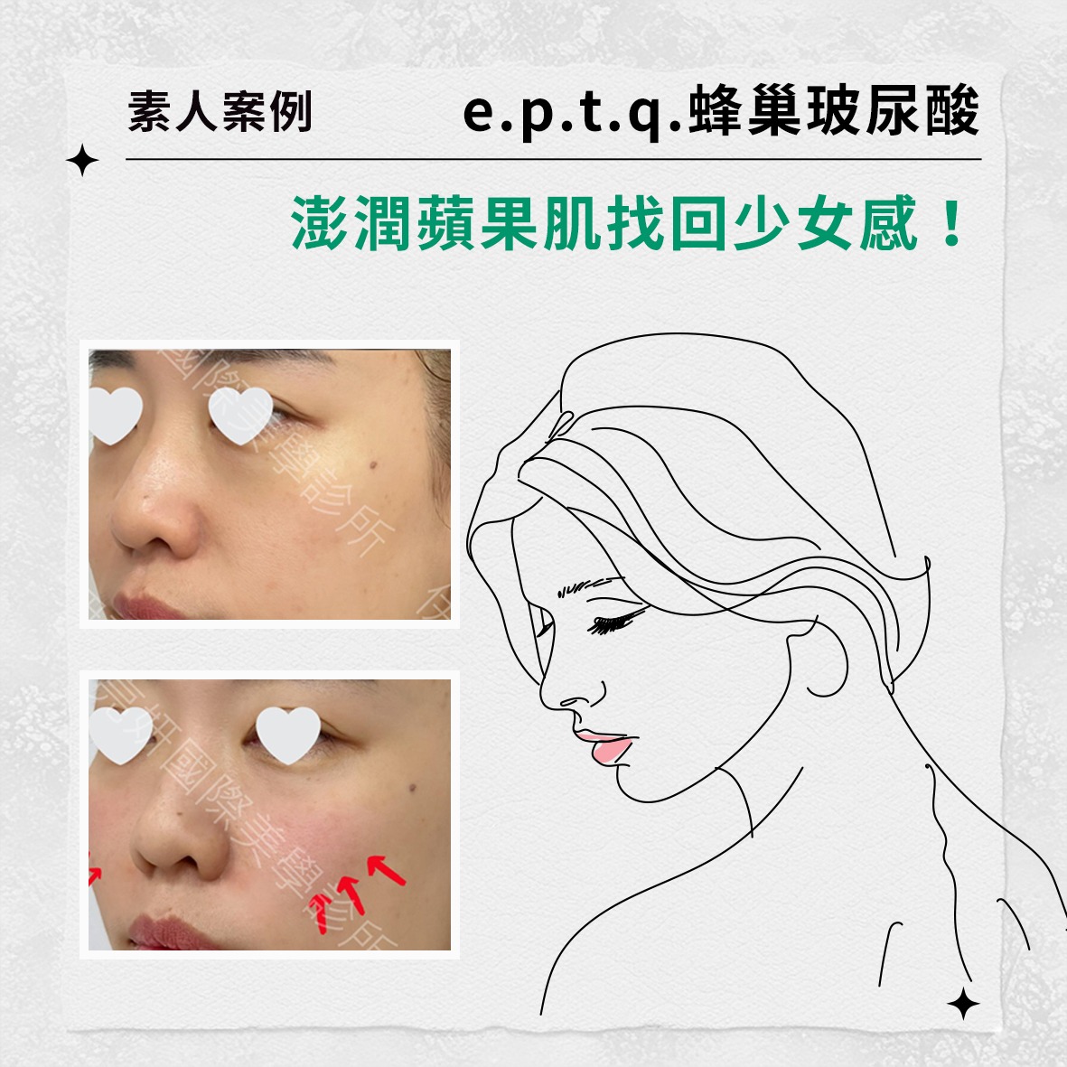 素人案例 |e.p.t.q.蜂巢玻尿酸，澎潤蘋果肌找回少女感！